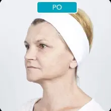 Zobacz zdjęcie: Termolifting Zafirro przed i po