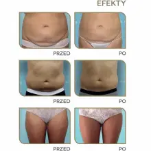 Zobacz zdjęcie: Prawdziwe efekty zabiegu kriolipoliza Cooltech w Domu Urody!
