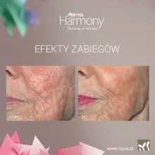 Zobacz zdjęcie: Efekty zabiegu