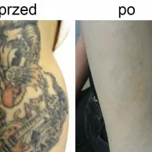 Zobacz zdjęcie: Usuwanie tatuaży