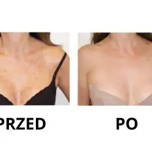Zobacz zdjęcie: Nowa maszyna w Bednarczuk Beuty Clinic efekty zabiegów