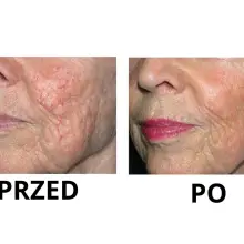 Zobacz zdjęcie: Nowa maszyna w Bednarczuk Beuty Clinic efekty zabiegów
