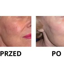 Zobacz zdjęcie: Nowa maszyna w Bednarczuk Beuty Clinic efekty zabiegów