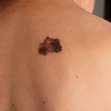 View photo: Cancerous mole on the skin