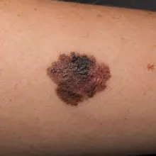 View photo: Cancerous mole on the skin
