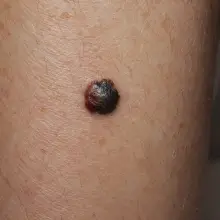 View photo: Cancerous mole on the skin